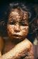 180px-child-with-smallpox-bangladesh.jpg