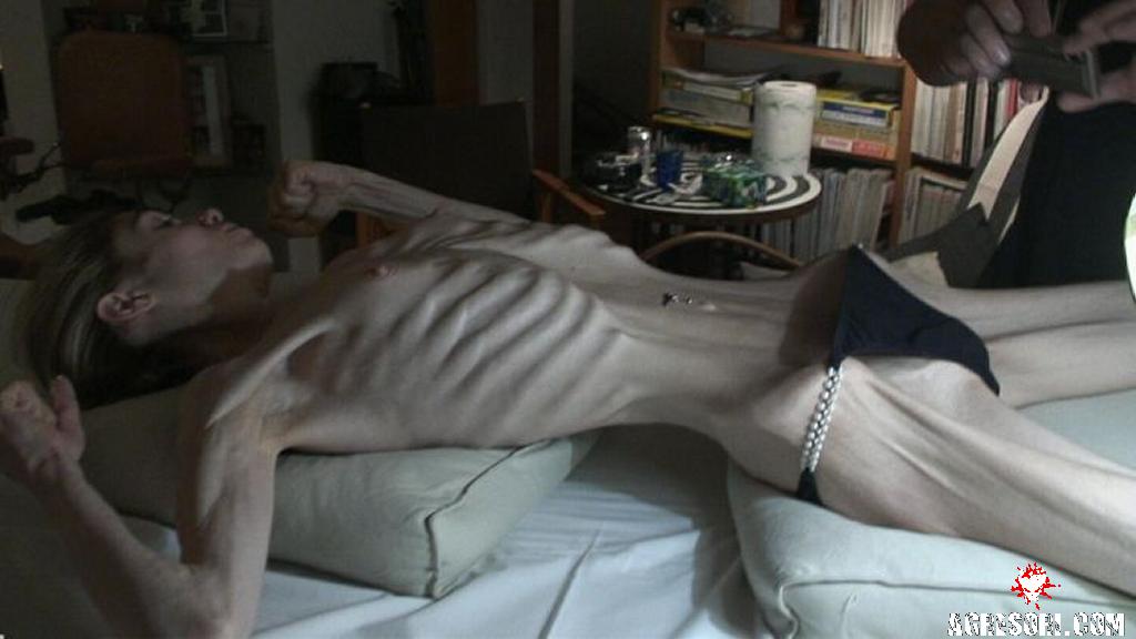 anorexia-01.jpg